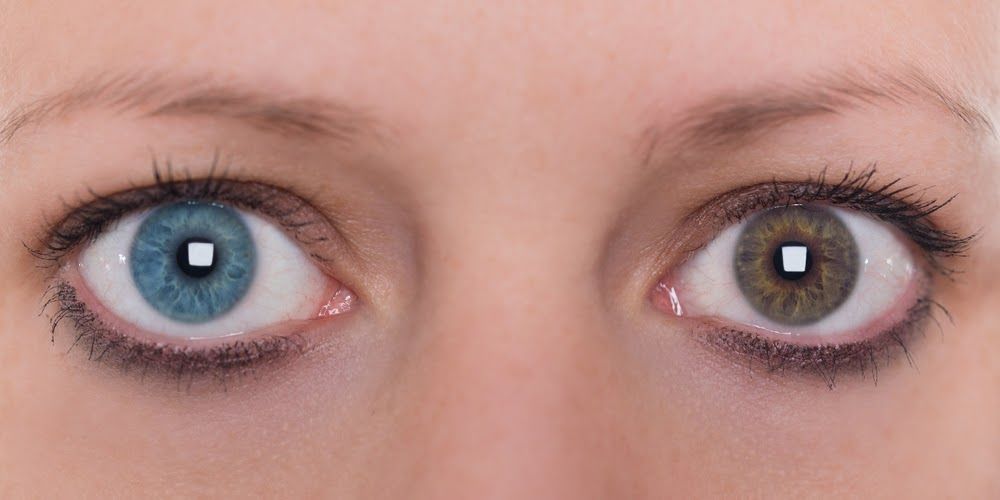 latisse eye discoloration